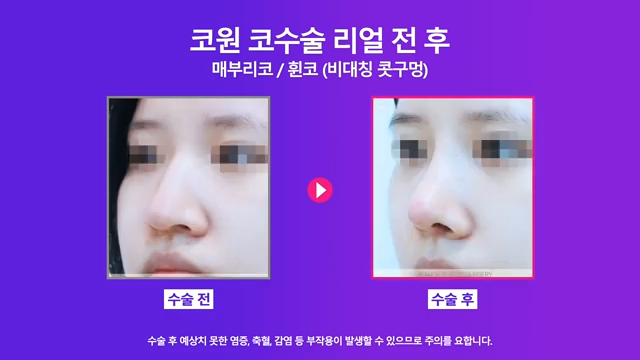 매부리코수술 코끝올리기로 콧구멍비대칭 개선한 사례 사진 7