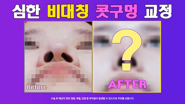 매부리코수술 코끝올리기로 콧구멍비대칭 개선한 사례