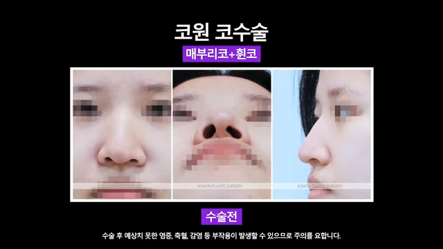 매부리코수술 코끝올리기로 콧구멍비대칭 개선한 사례 사진 4