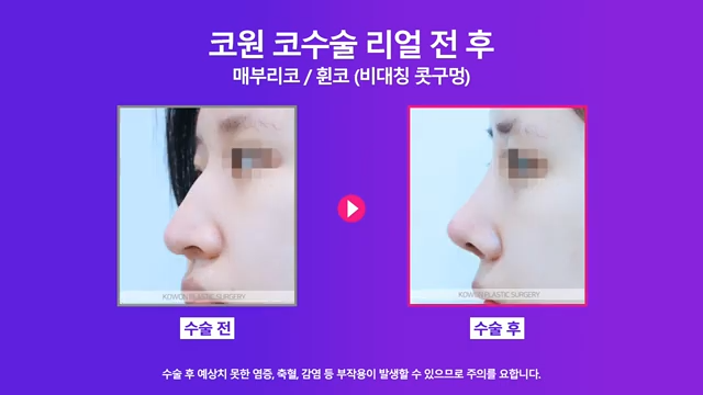 매부리코수술 코끝올리기로 콧구멍비대칭 개선한 사례 사진 8