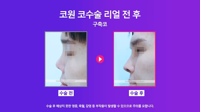 남자코재수술, 코수술구축 실리콘 부작용 개선한 사례 사진 6