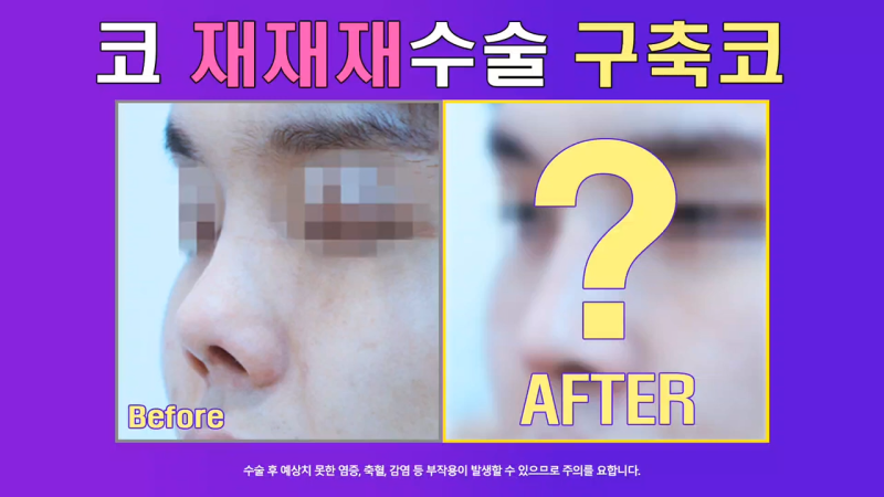남자코재수술, 코수술구축 실리콘 부작용 개선한 사례
