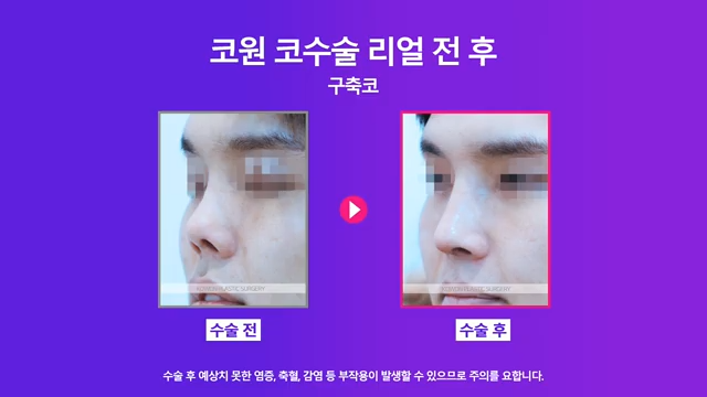 남자코재수술, 코수술구축 실리콘 부작용 개선한 사례 사진 5