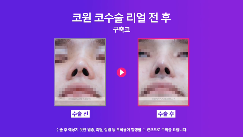 남자코재수술, 코수술구축 실리콘 부작용 개선한 사례 사진 8