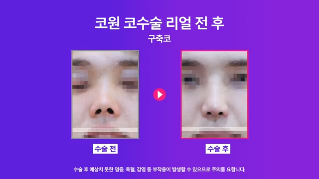 남자코재수술, 코수술구축 실리콘 부작용 개선한 사례 사진 7