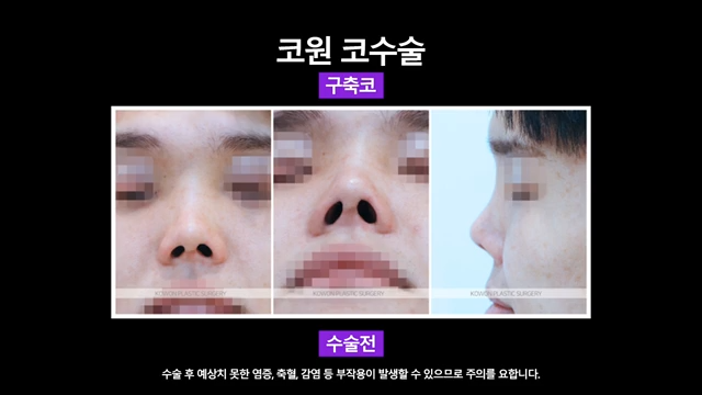 남자코재수술, 코수술구축 실리콘 부작용 개선한 사례 사진 4