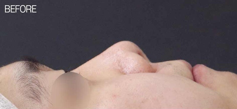 낮은코성형, 들창코 수술 시 비중격만곡증 함께 개선할 수 있습니다. 사진 6