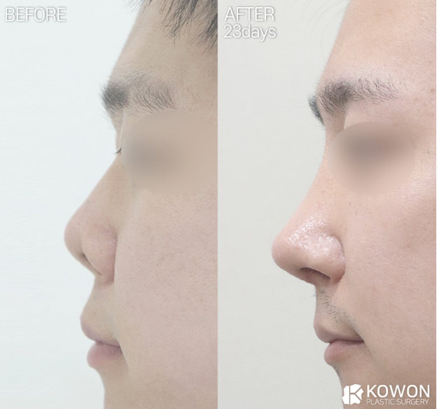 낮은코성형, 들창코 수술 시 비중격만곡증 함께 개선할 수 있습니다. 사진 5