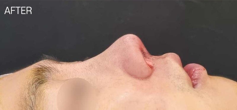 낮은코성형, 들창코 수술 시 비중격만곡증 함께 개선할 수 있습니다. 사진 7