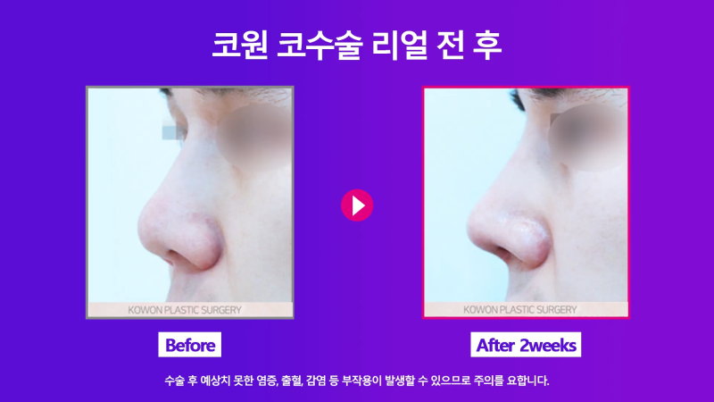 신사역코재수술, 쁘띠성형 코필러제거 깔끔하게 마친 사례 사진 9