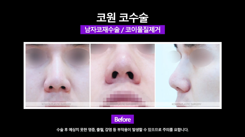 신사역코재수술, 쁘띠성형 코필러제거 깔끔하게 마친 사례 사진 5