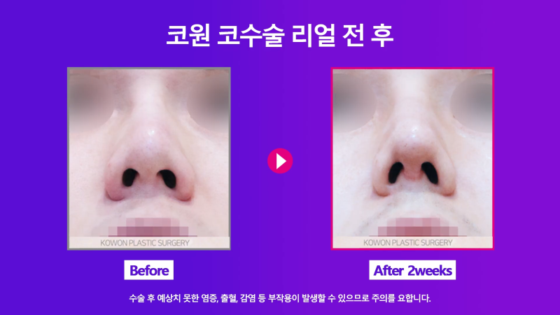 신사역코재수술, 쁘띠성형 코필러제거 깔끔하게 마친 사례 사진 7