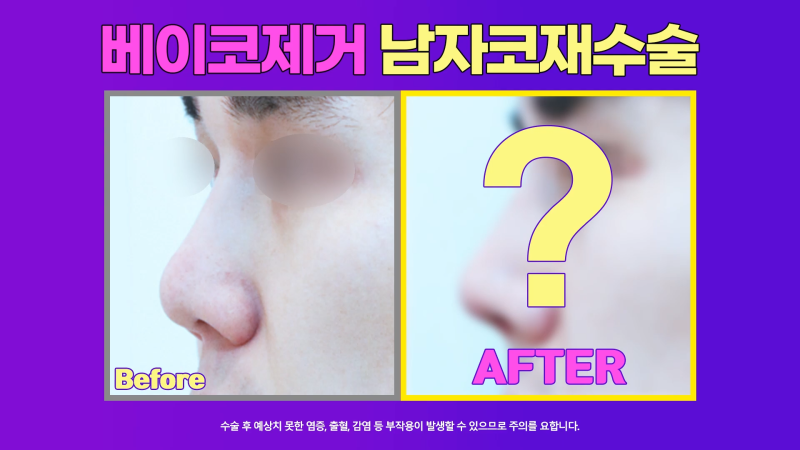 신사역코재수술, 쁘띠성형 코필러제거 깔끔하게 마친 사례