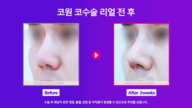 신사역코재수술, 쁘띠성형 코필러제거 깔끔하게 마친 사례 사진 8