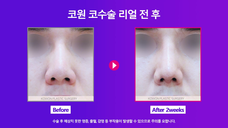 신사역코재수술, 쁘띠성형 코필러제거 깔끔하게 마친 사례 사진 6