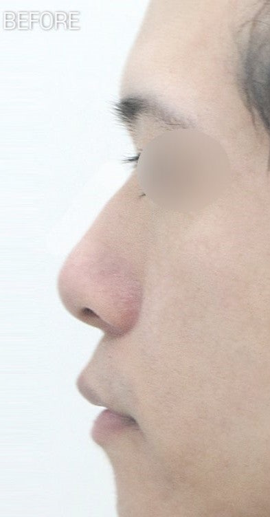 남자콧볼축소수술, 퍼진 콧볼 줄이기 성공적으로 변화할 수 있습니다. 사진 7