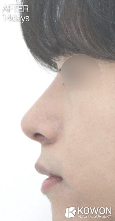 남자콧볼축소수술, 퍼진 콧볼 줄이기 성공적으로 변화할 수 있습니다. 사진 8