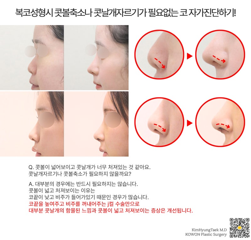 남자콧볼축소수술, 퍼진 콧볼 줄이기 성공적으로 변화할 수 있습니다.