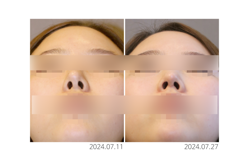 코끝재수술 들린코인 경우 이것을 꼭 확인해보세요. 사진 5