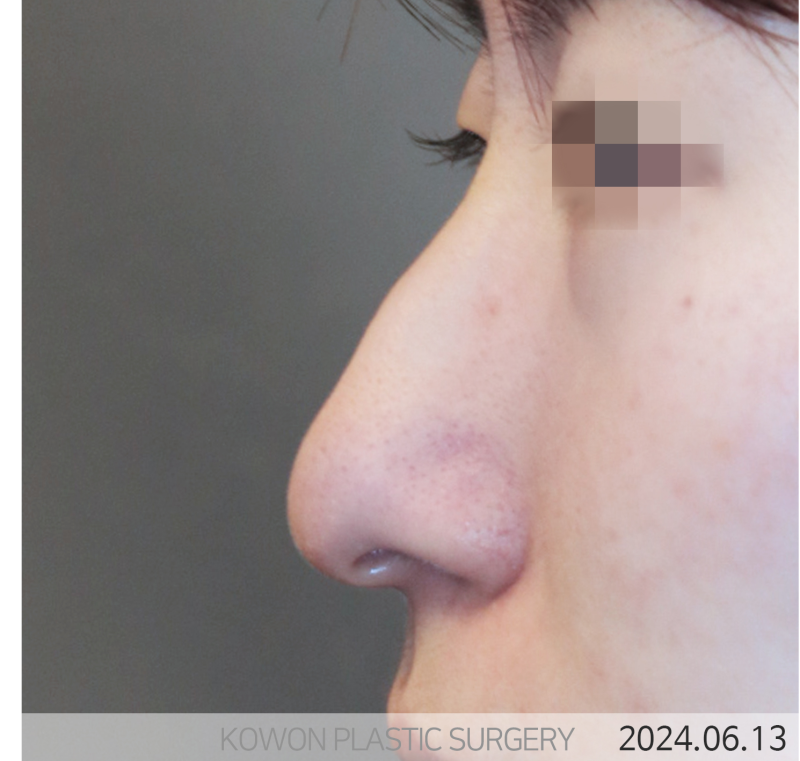 화살코성형, 매부리만 깎으면 안 되는 이유. 사진 5