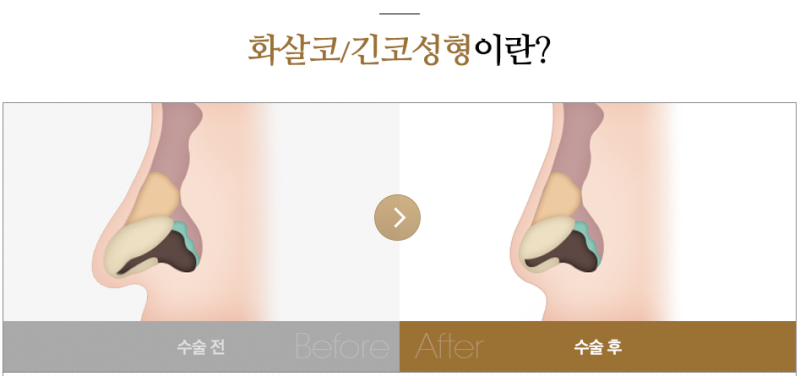 화살코성형, 매부리만 깎으면 안 되는 이유.