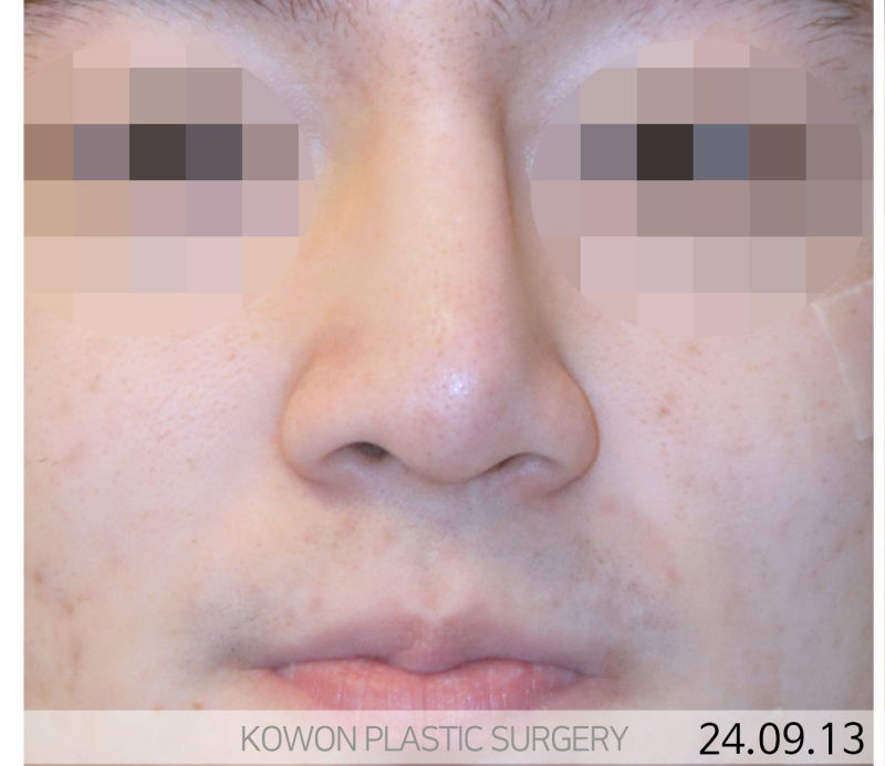 휜코수술잘하는곳, 늑연골코수술 어디서부터 시작해야 할까? 사진 4