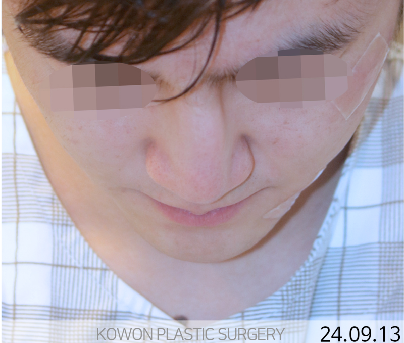 휜코수술잘하는곳, 늑연골코수술 어디서부터 시작해야 할까? 사진 5