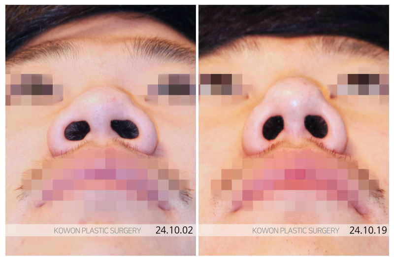 남자복코성형 늑연골코수술 전국에서 찾는 이유가 있습니다 사진 5