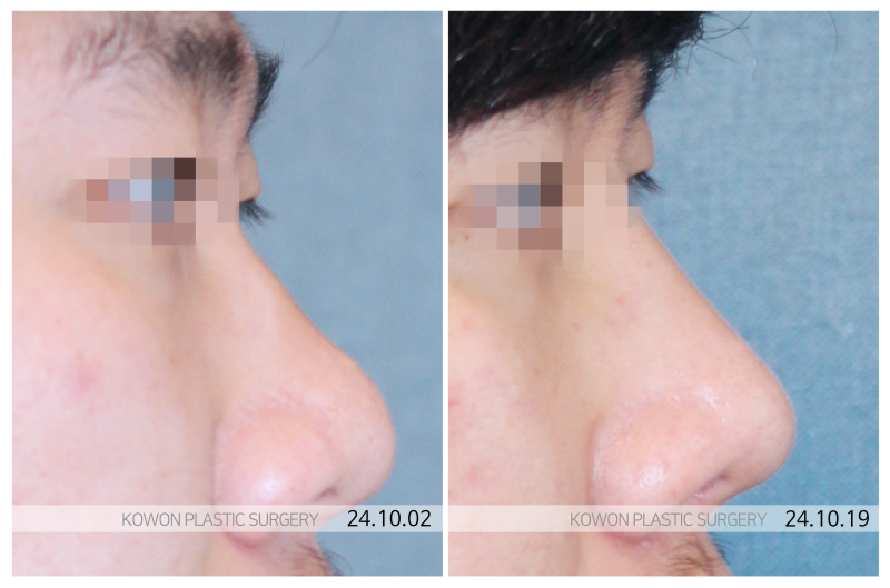 남자복코성형 늑연골코수술 전국에서 찾는 이유가 있습니다 사진 6