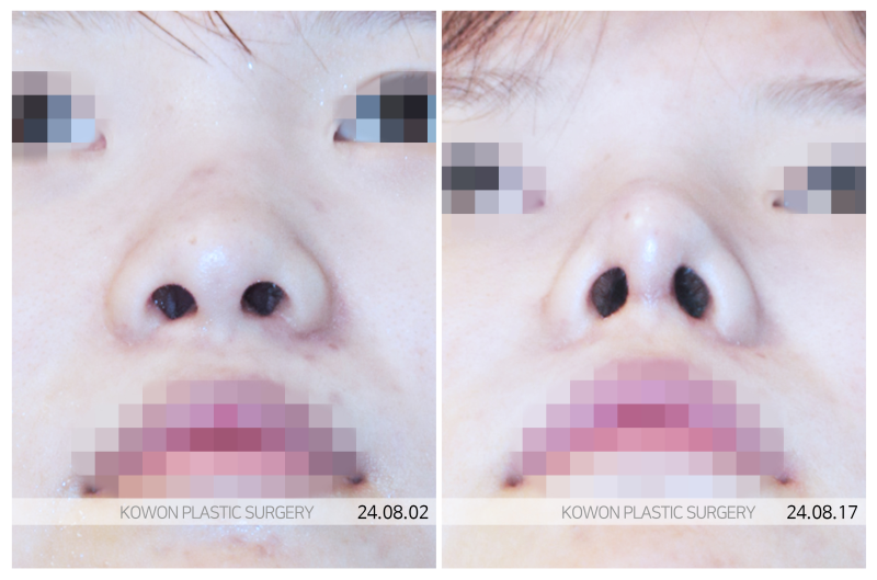 늑연골코수술 코끝무너짐 막을 수 있는 꿀팁 사진 6