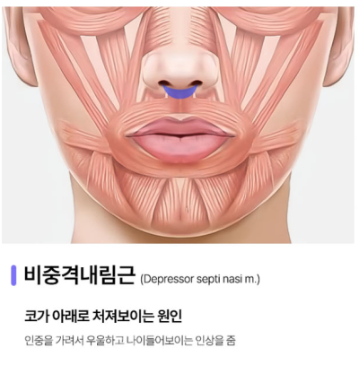 코근육교정, 웃을 때 퍼져 보이는 이유는 따로 있습니다. 사진 3