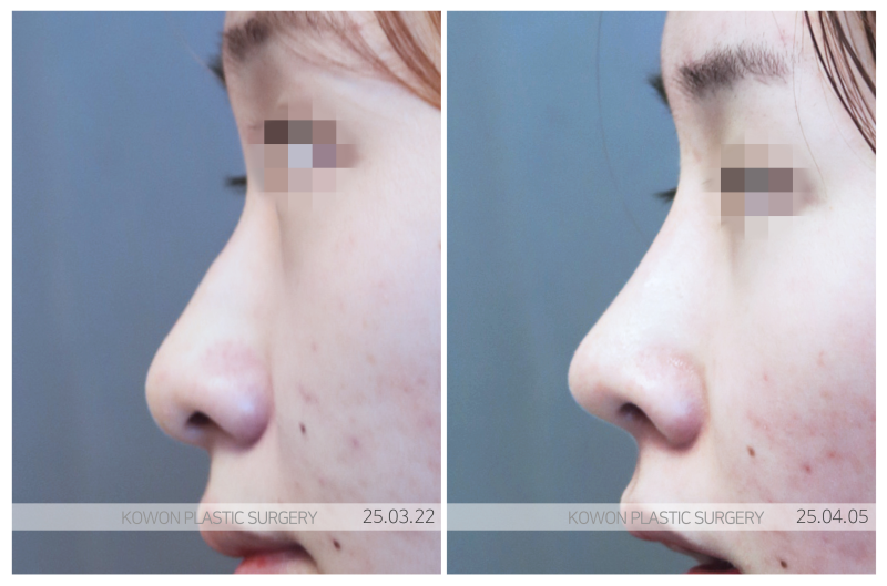 자가연골코수술 잘하는 곳은 다릅니다 사진 3