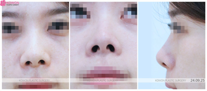 들창코수술비용 하나부터 열까지 다 알려드려요. 사진 3