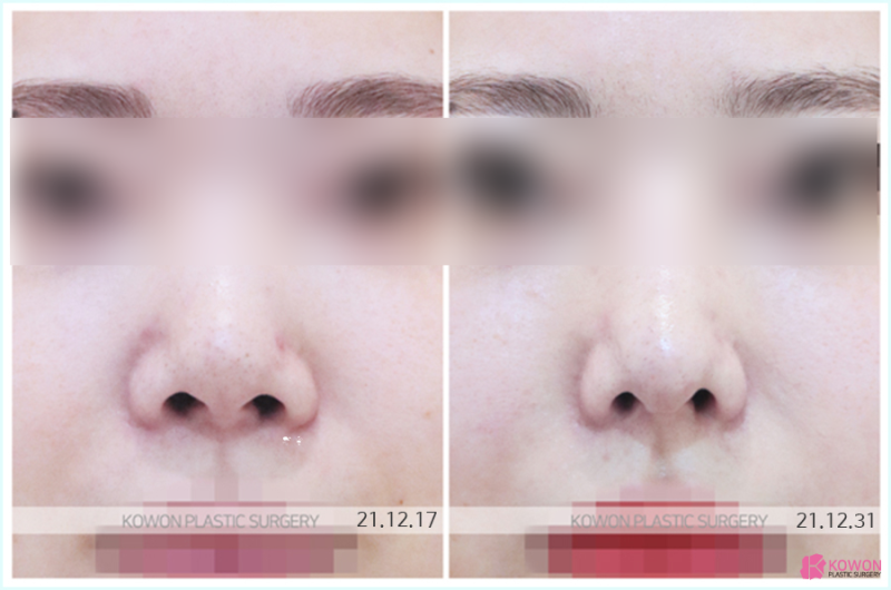 늑연골코성형 잘하는 곳? 딱 3가지만 알아보세요. 사진 6