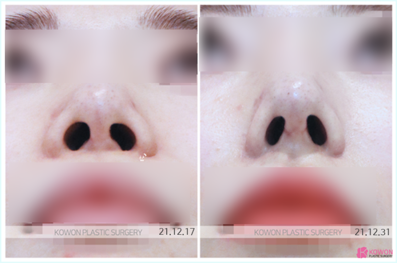 늑연골코성형 잘하는 곳? 딱 3가지만 알아보세요. 사진 8