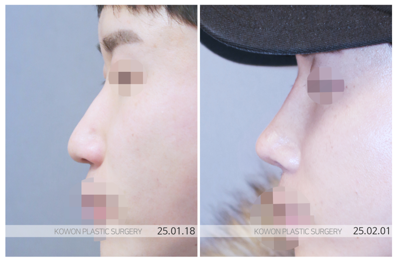 남자콧대수술, ‘OO’부터 시작해야 합니다. 사진 5