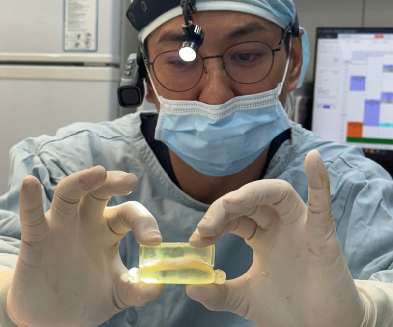 리브핏, 자가늑연골로 만든 자연스러운 코성형 사진 3