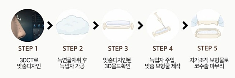 리브핏, 자가늑연골로 만든 자연스러운 코성형 사진 7