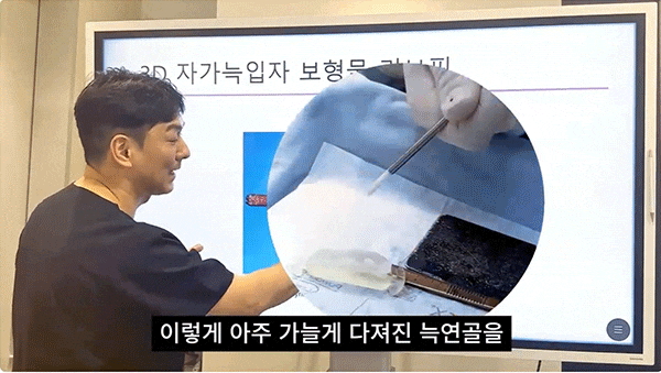 리브핏, 자가늑연골로 만든 자연스러운 코성형 사진 8