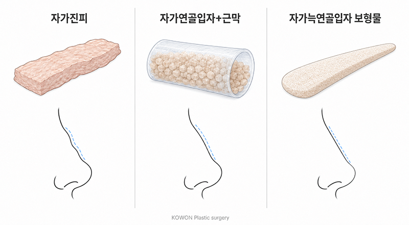 리브핏, 자가늑연골로 만든 자연스러운 코성형 사진 5