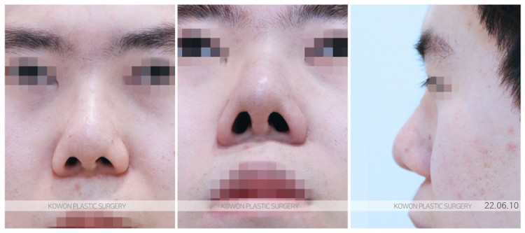 코재수술비용, 결정 전 꼭 확인할 것들 사진 4