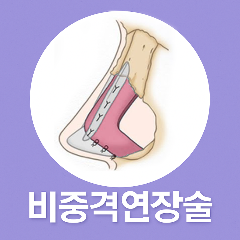 코성형 전후, 달라진 모습과 꼭 확인할 점 사진 5