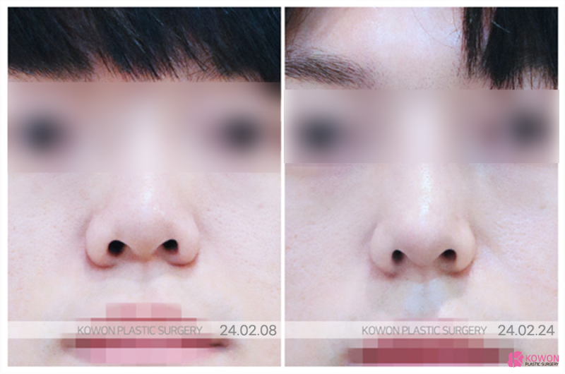 코성형 전후, 달라진 모습과 꼭 확인할 점 사진 7