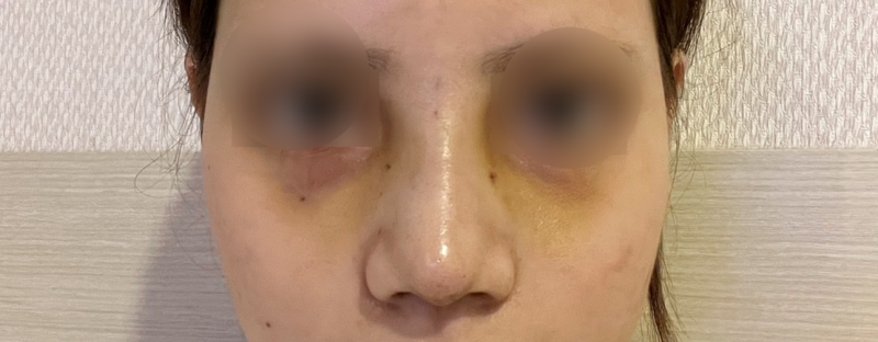 코수술 붓기 더 빨리 뺄 수 있는 방법 사진 4