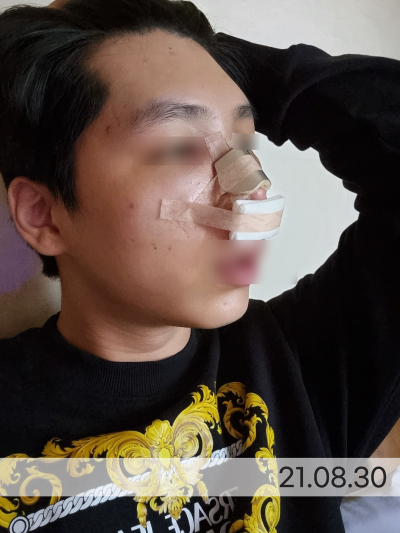 코수술 붓기 더 빨리 뺄 수 있는 방법 사진 3