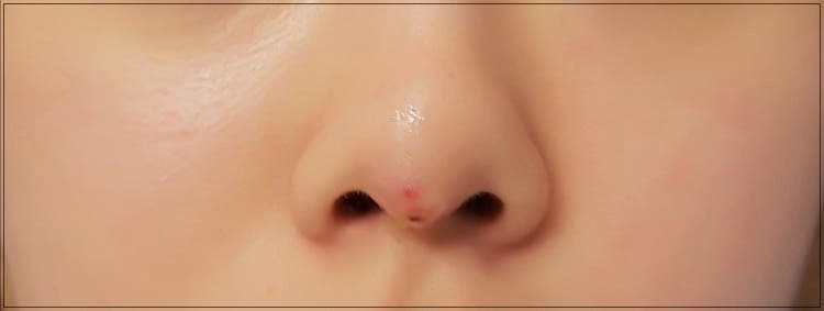 코수술 붓기 더 빨리 뺄 수 있는 방법 사진 5