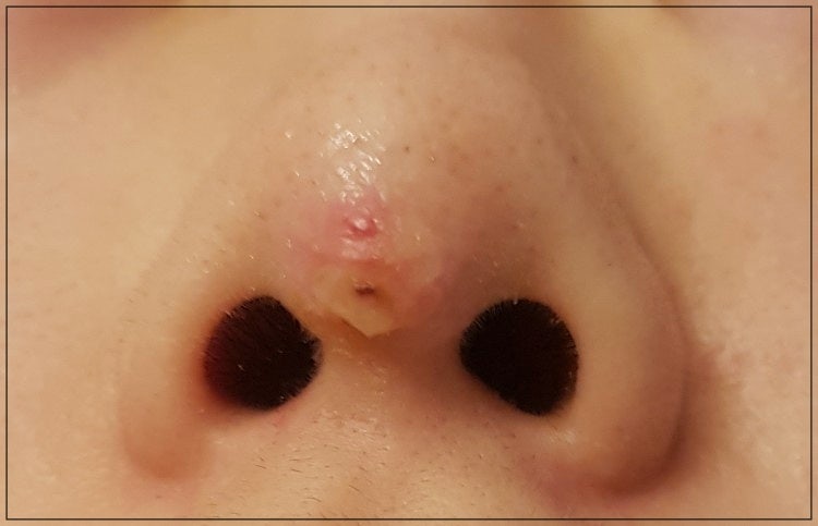 코수술 붓기 더 빨리 뺄 수 있는 방법 사진 6