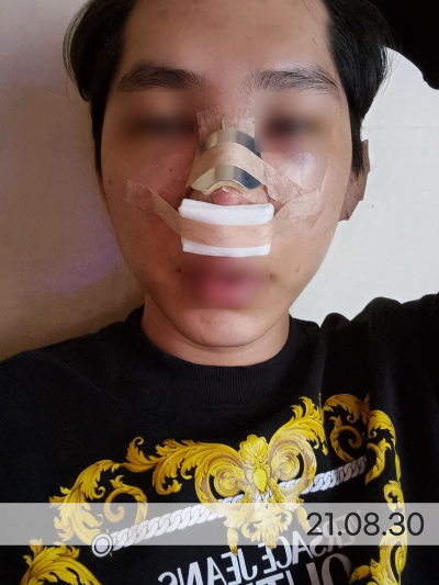 코수술 붓기 더 빨리 뺄 수 있는 방법