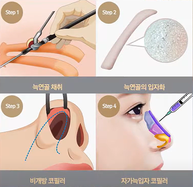 비절개 코수술, 복코 탈출하고 싶다면 필독 사진 7