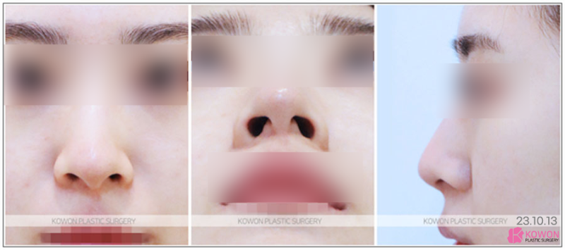 무보형물 코수술, 구축 없이 오래 유지될 수 있을까요? 사진 4